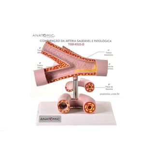 Artéria Saudável e Patológica Comparação Modelo Anatomia