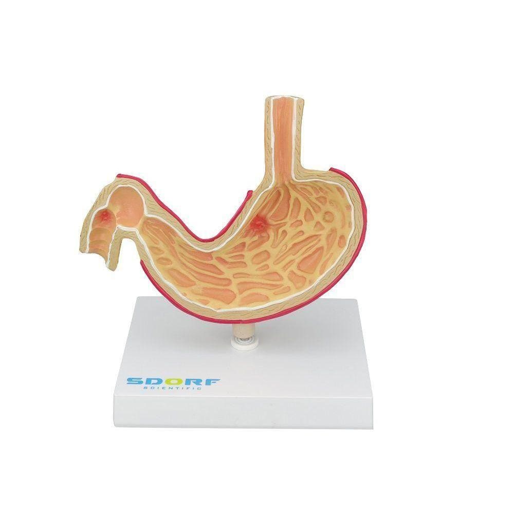 Modelo Patológico Do Estômago