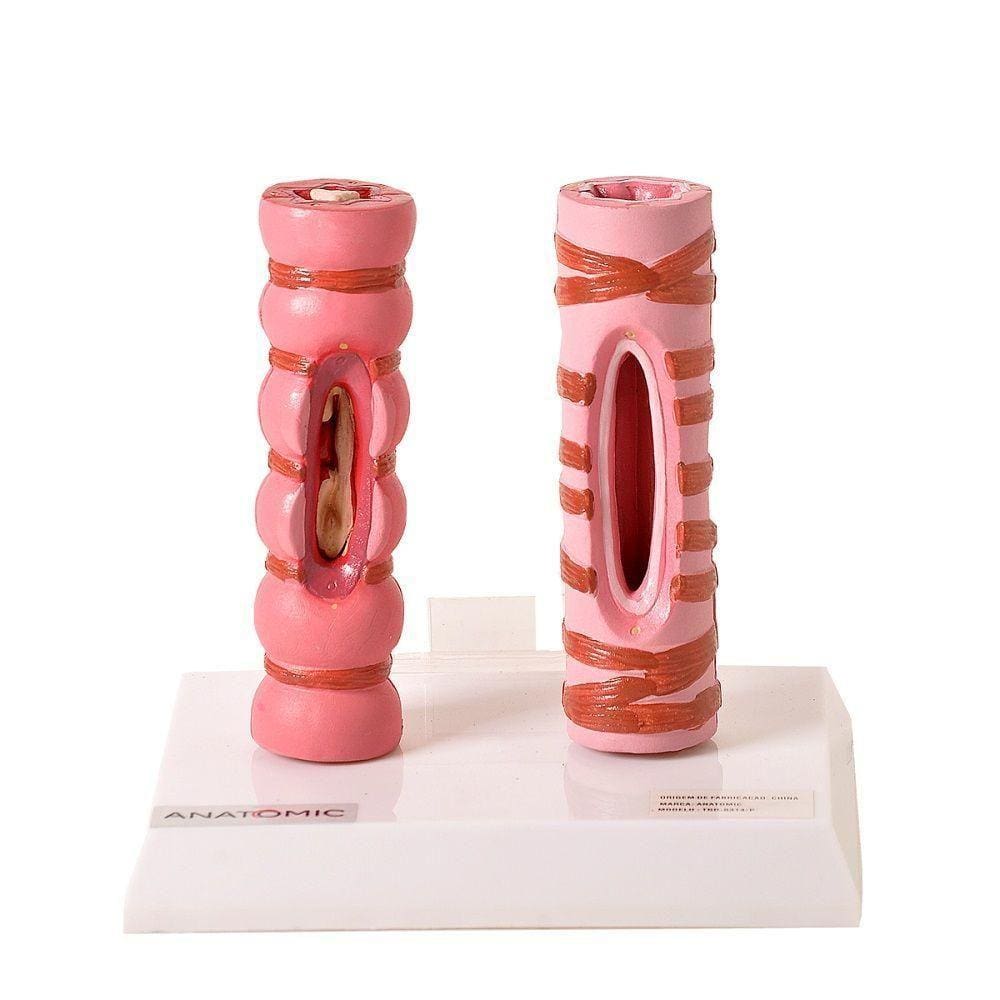 Brônquio Saudável e Patológico Comparação