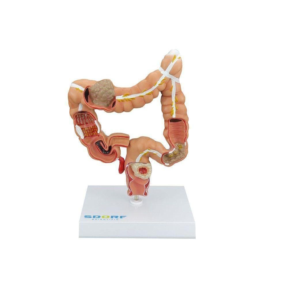 Modelo Patológico do Cólon e Reto SD-5203