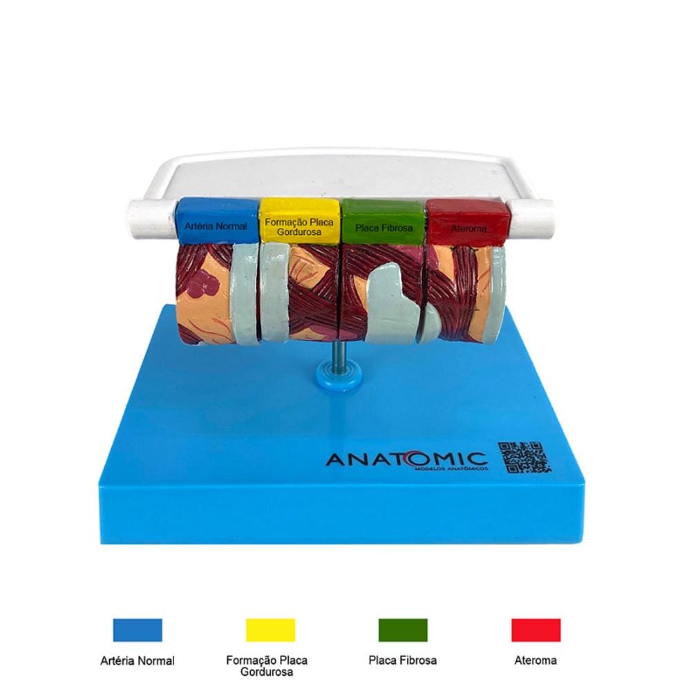 Brônquio Saudável e Patológico