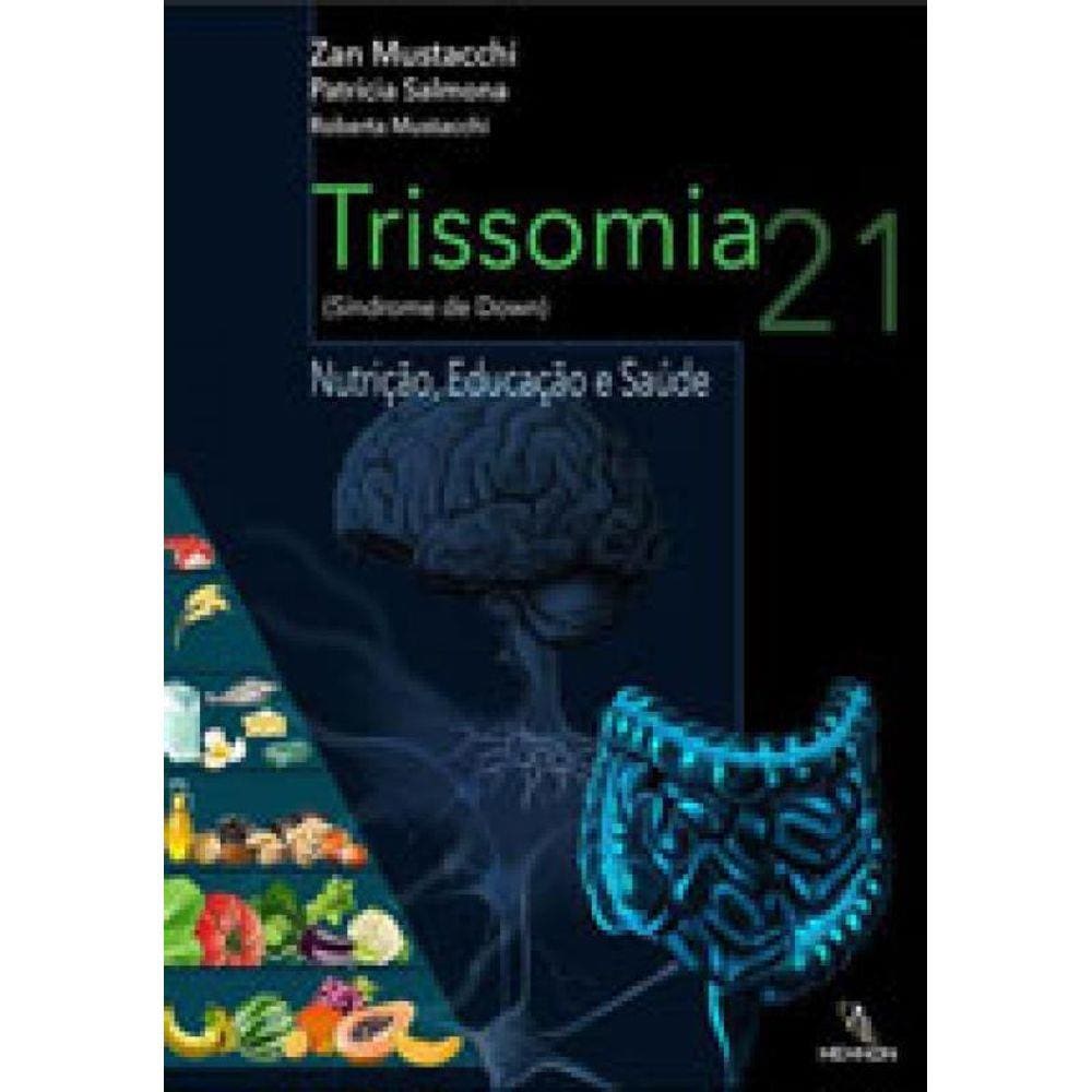 Trissomia 21 (Sindrome De Down)