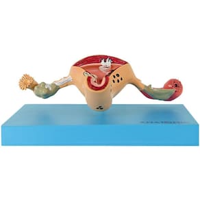 Útero Com Trompas Patológico Em Prancha, Anatomia