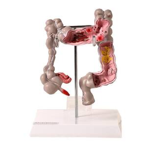 Intestino Grosso Humano Com Patologia, Anatomia