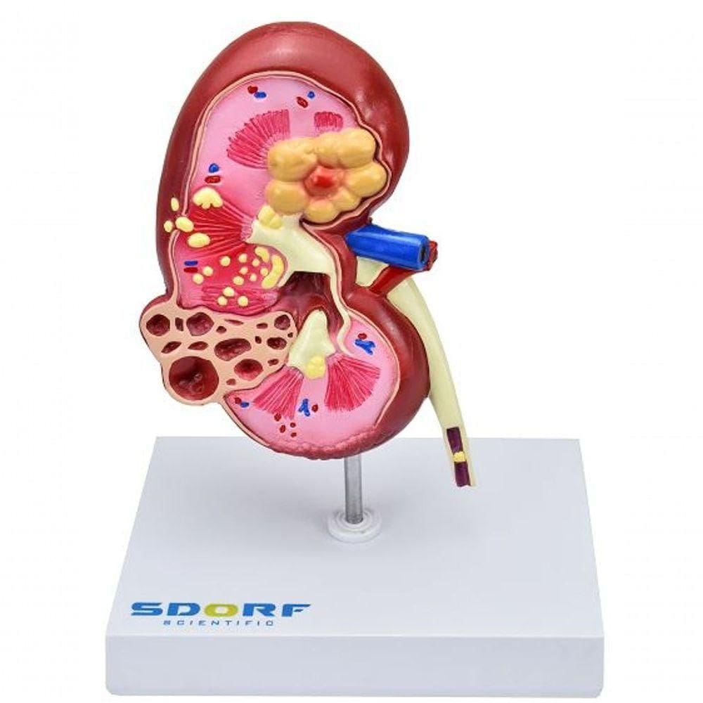 Modelo Patológico Do Rim