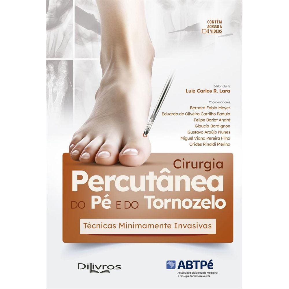 Cirurgia Percutanea Do Pe E Do Tornozelo:Tecnicas Minimamente Invasivas