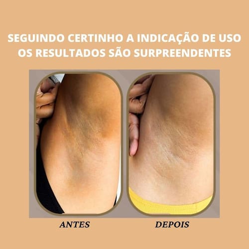 Clareamento De Pele Íntima Virilha Axila E Entre Casas Bahia