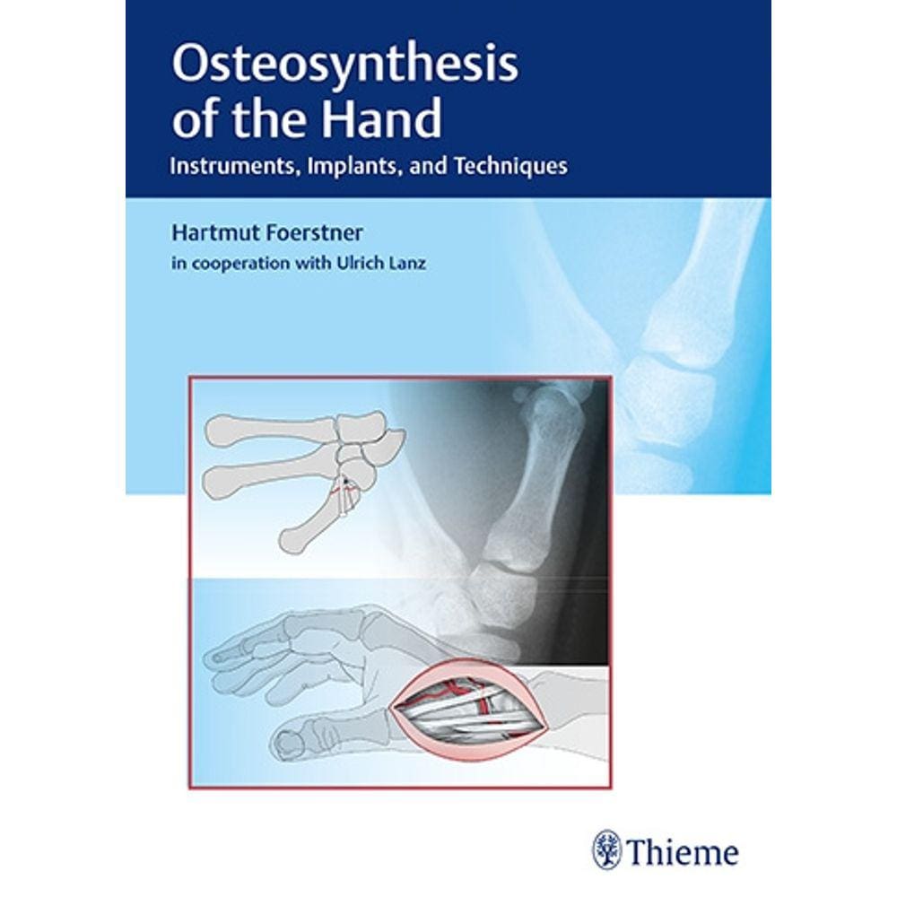 Osteosynthesis Of The Hand