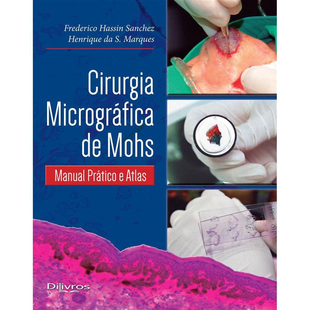 Cirurgia Micrografica De Mohs