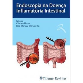 Endoscopia Na Doenca Inflamatoria Intestinal