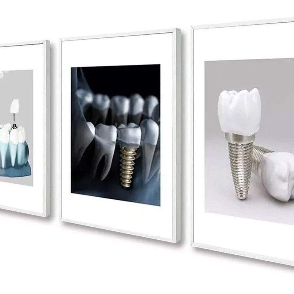 Kit 3 Quadros Decorativos Odontologia Implante Dentista Sala 60x40 Vinil Colorido
