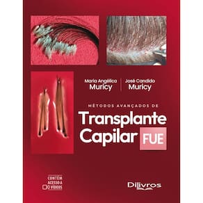 Métodos Avançados de Transplante Capilar Fue