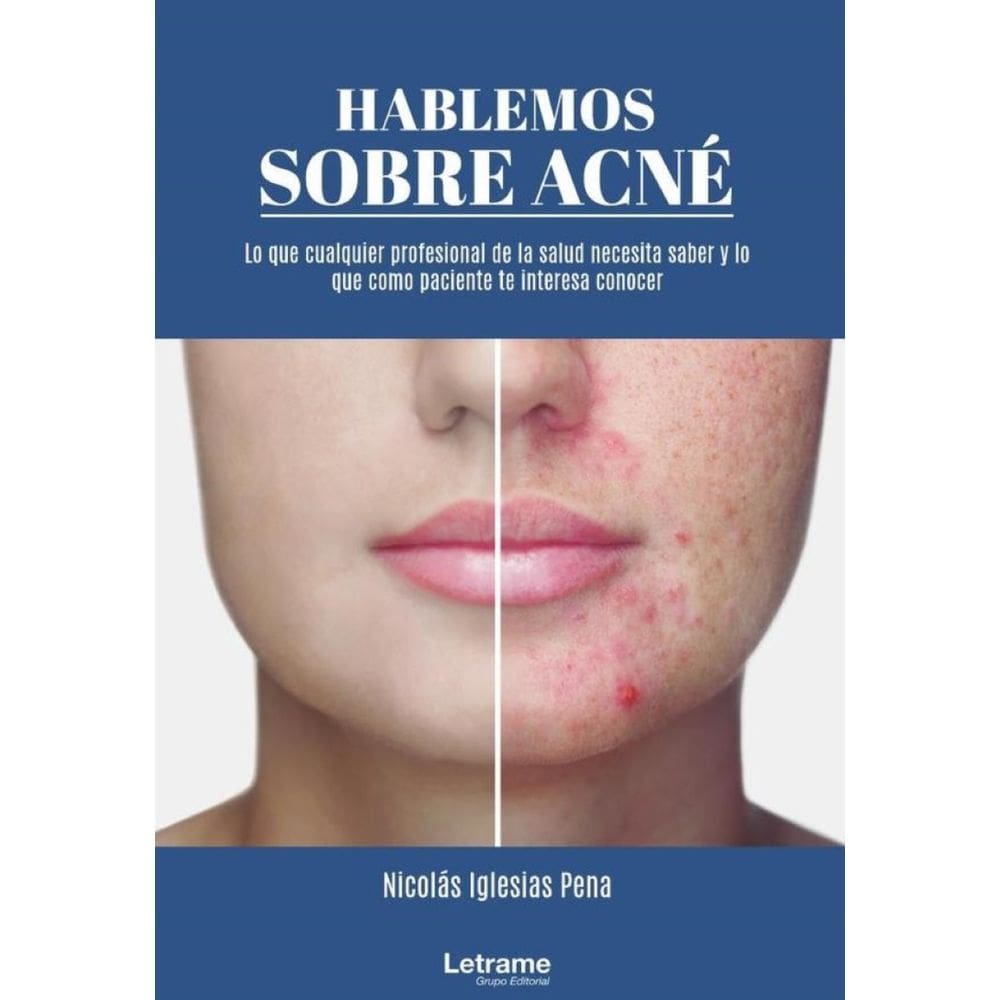 Hablemos sobre acné - Espanhol