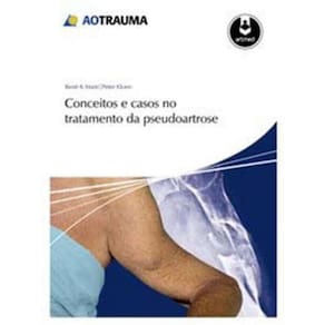 Conceitos e Casos No Tratamento Da Pseudoartrose
