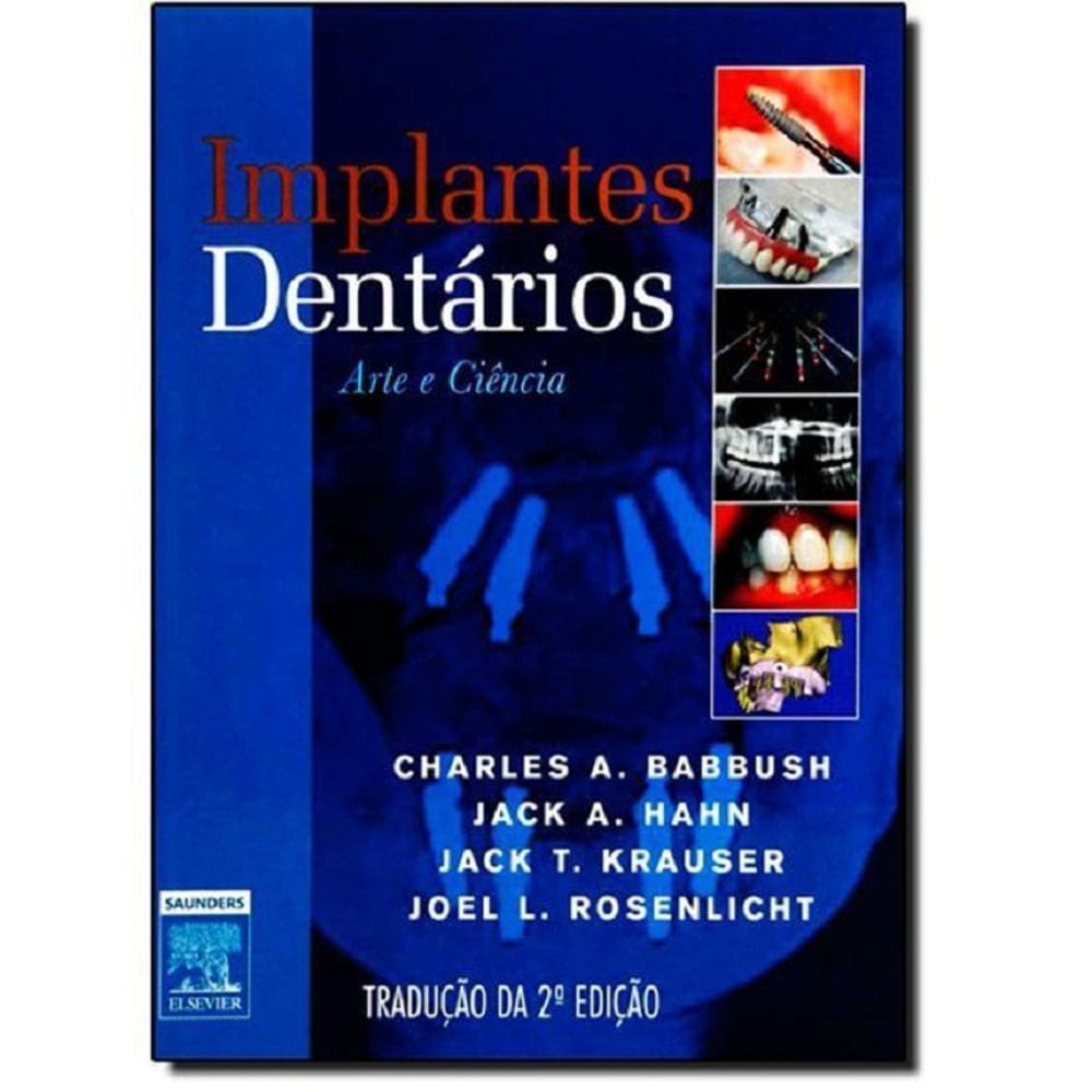 Implantes Dentários: Arte e Ciência