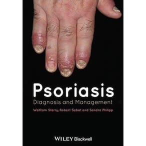 Psoriasis: Diagnosis And Management