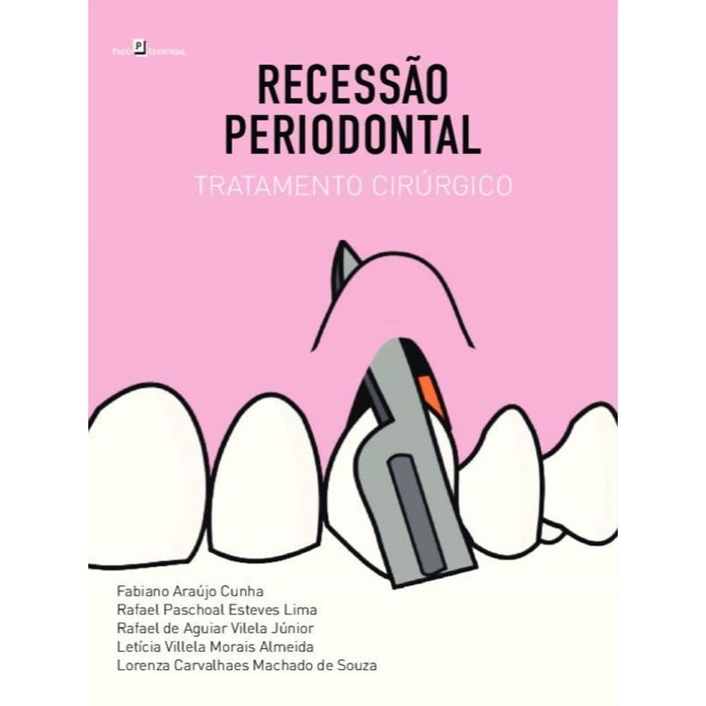 Recessão Periodontal