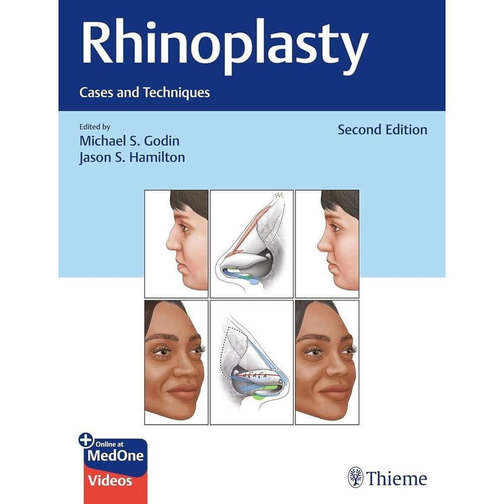 Rhinoplasty Cases And Techniques