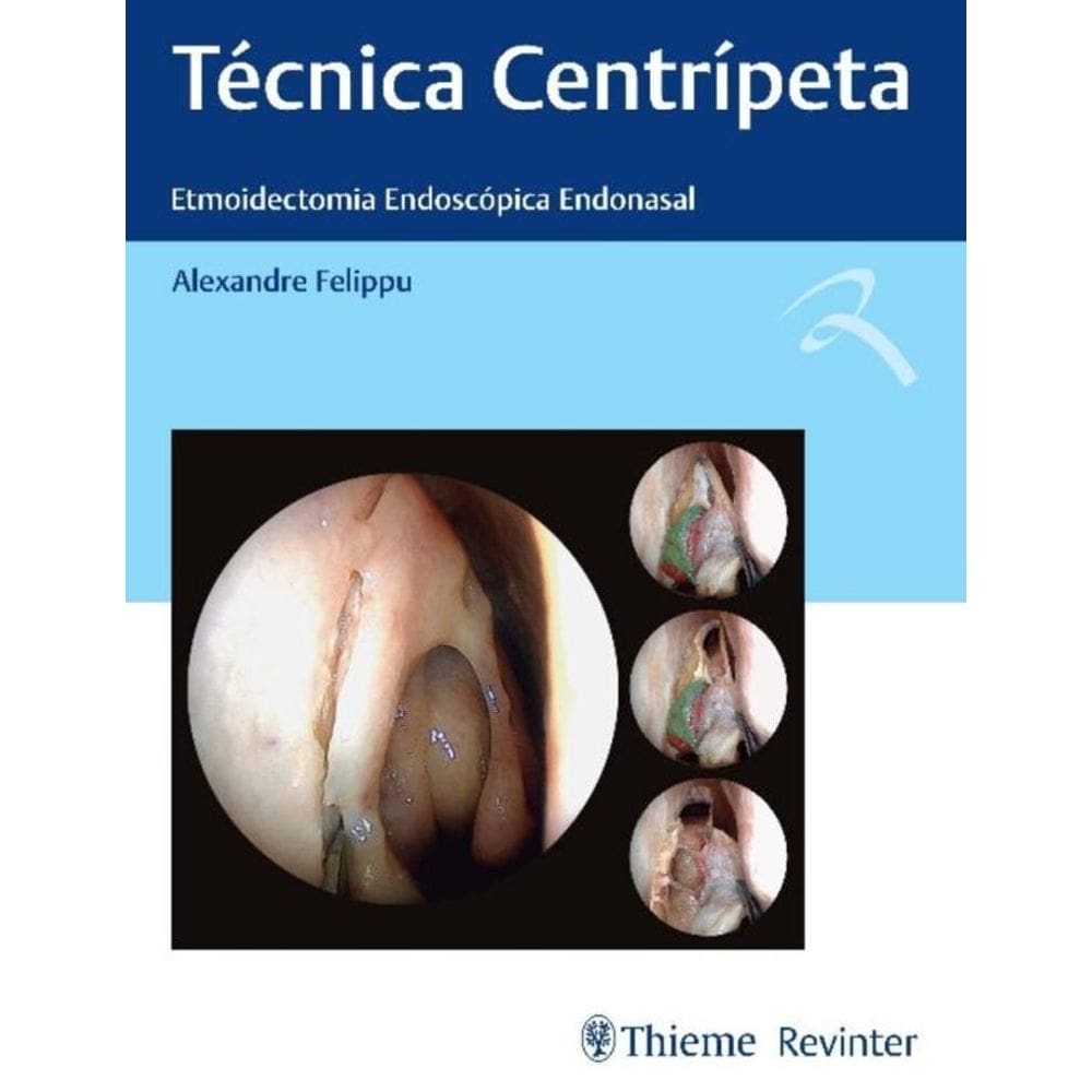 Técnica Centrípeta - Etmoidectomia Endoscópica Endonasal