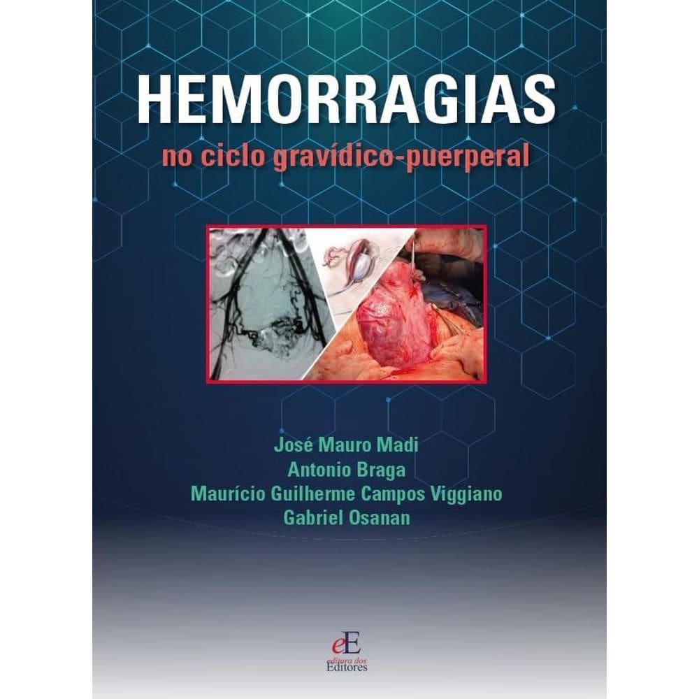 Hemorragias do Ciclo Gravídico Puerperal