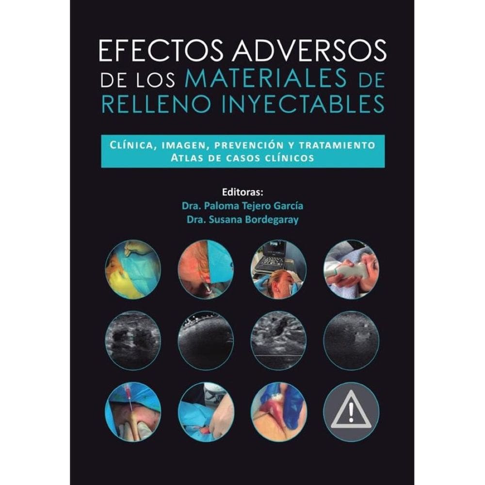 Efectos adversos de los materiales de relleno inyectables - Espanhol