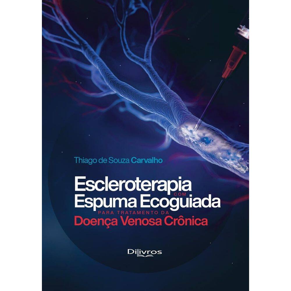Escleroterapia Com Espuma Ecoguiada