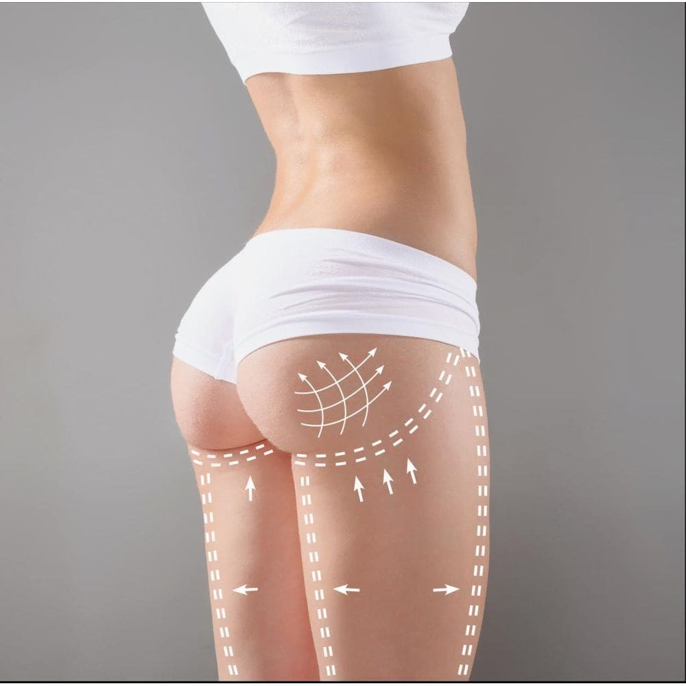 Acido Hialuronico 20Ml Gluteos, Bumbum, Cross Link- Anvisa