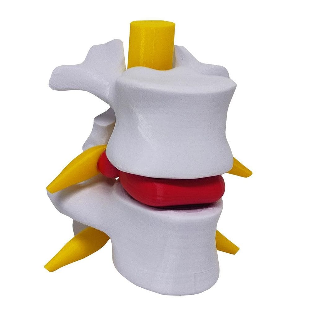 Modelo Anatômico Hérnia Disco Lombar Coluna Vertebral