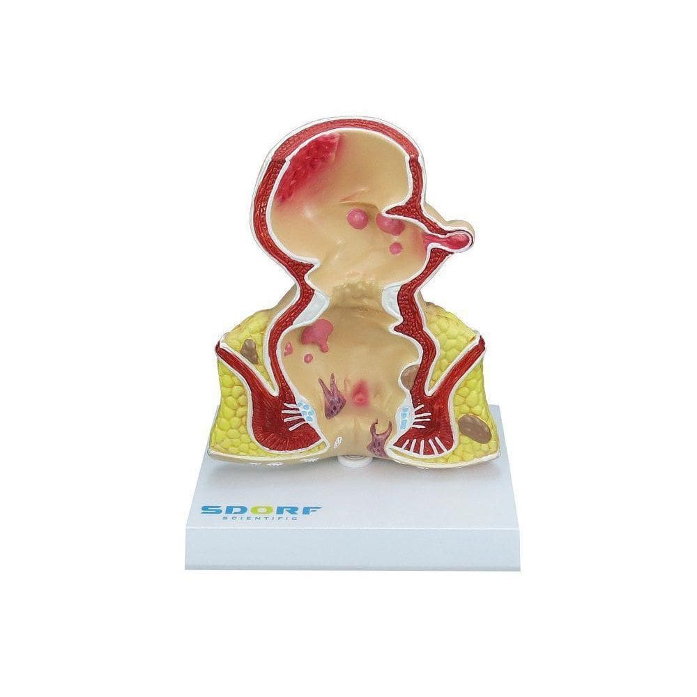 Modelo Patológico Do Reto