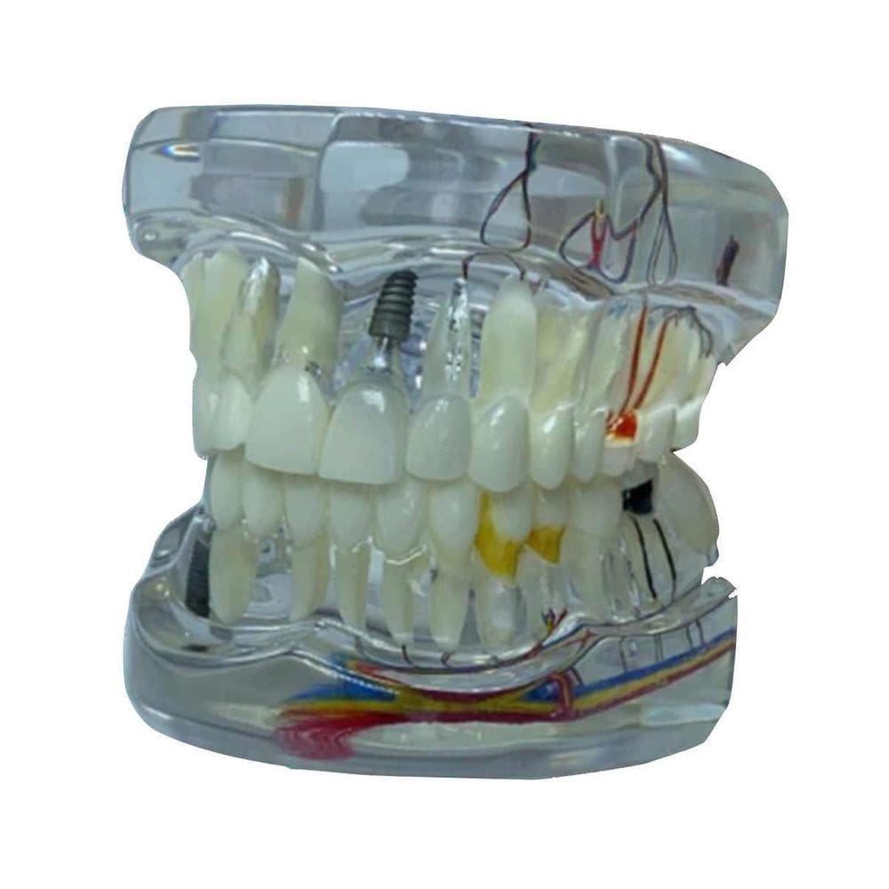Macro Modelo Anatômico Odontológico Com Próteses E Implantes